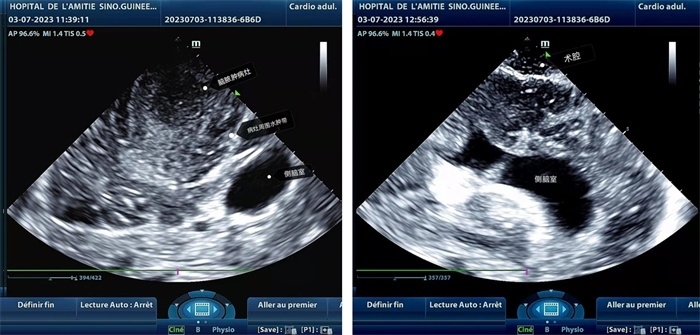 左圖顯示術(shù)中超聲見(jiàn)囊實(shí)性病變，大小約為4x4x3cm，病灶周圍腦組織水腫明顯；右圖為病灶切除后，術(shù)中超聲示術(shù)腔無(wú)病變殘留