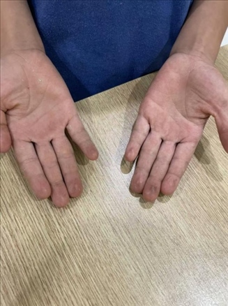 9歲小學(xué)生長期拍煙卡，手部粗糙長繭。受訪者供圖