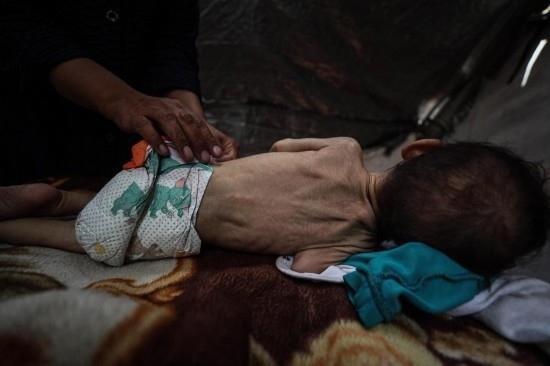 這是5月28日在加沙城西部一處臨時安置點(diǎn)拍攝的一名營養(yǎng)不良的嬰兒。新華社發(fā)（馬哈茂德·扎基攝）